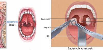 bademcik-geniz-eti-ameliyati-609x300