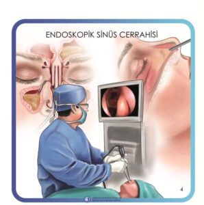 endoskopik_sinüs